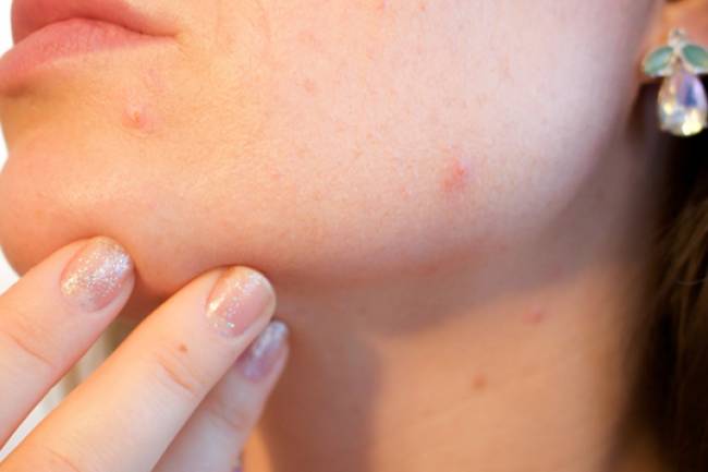 Using Vitamin A for Acne