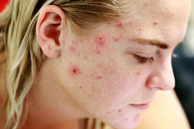 Zinc Tablets for Acne: Do They Really Help?